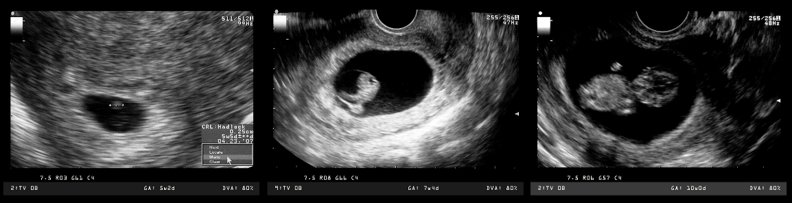 Shari Richard webinar Wednesday image of earl ultrasound